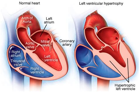 concentric hypertrophy treatment.